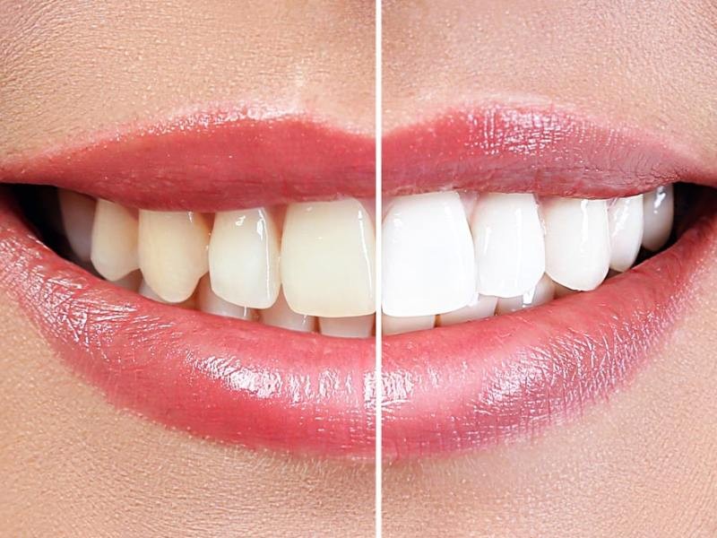 Tudo sobre clareamento dental