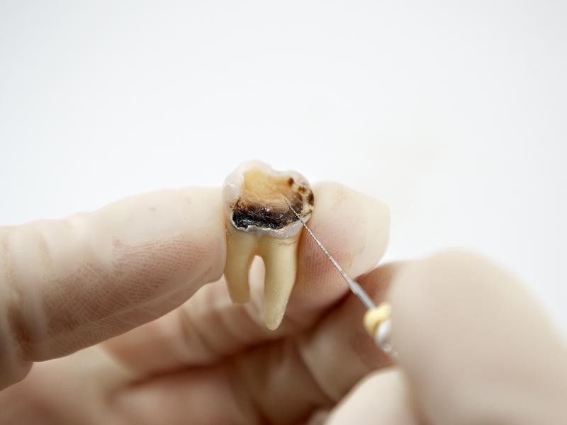 Recuperação após o Tratamento de Desvitalização dos Canais: Cuidados Essenciais