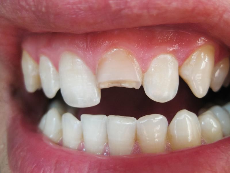 Quebrei o Dente: O que Fazer Agora?