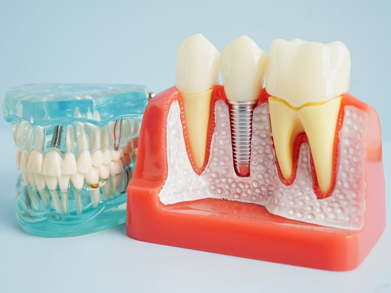 Quanto Custa um Implante Dentário? Saiba Quais os Factores que Influenciam o Preço