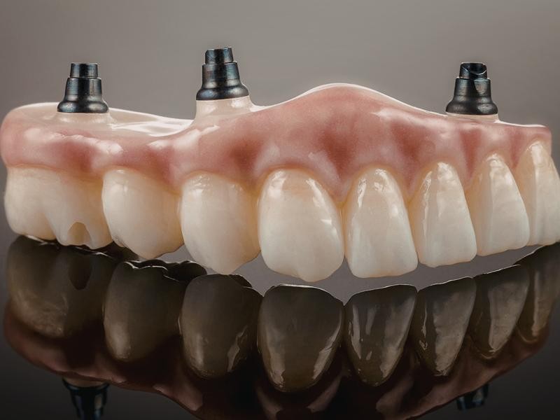 Quanto Tempo Dura uma Prótese Dentária Feita com CadCam?