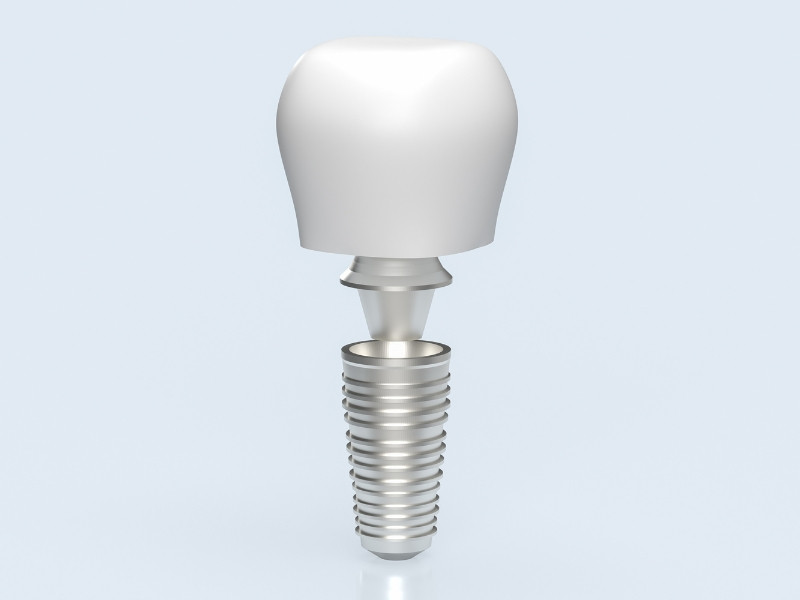 Consulta de Medicina Dentária para Implantes
