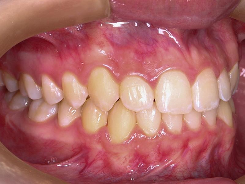 Sensibilidade Dentária