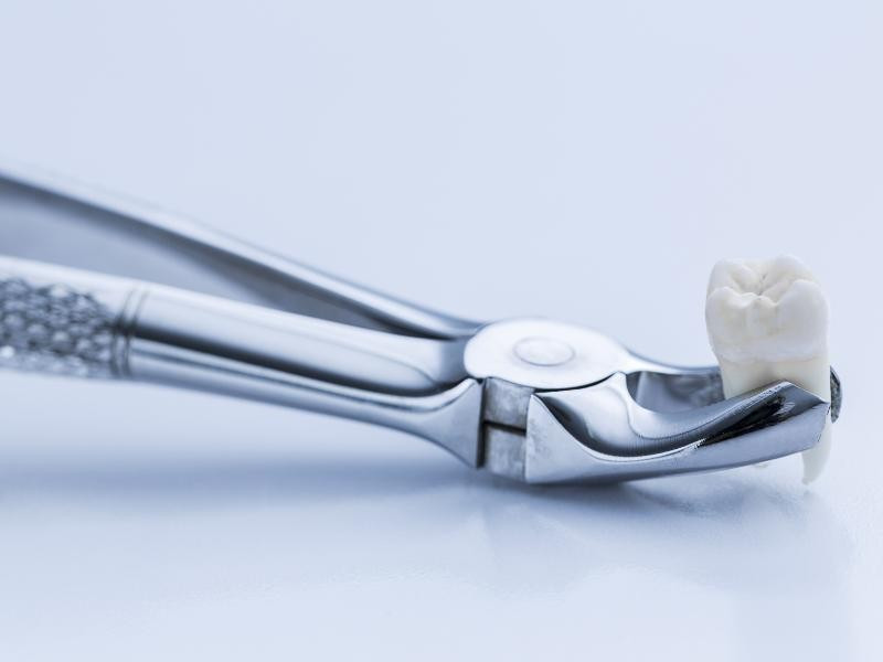 Consulta de Medicina Dentária para Extração de Dente do Siso