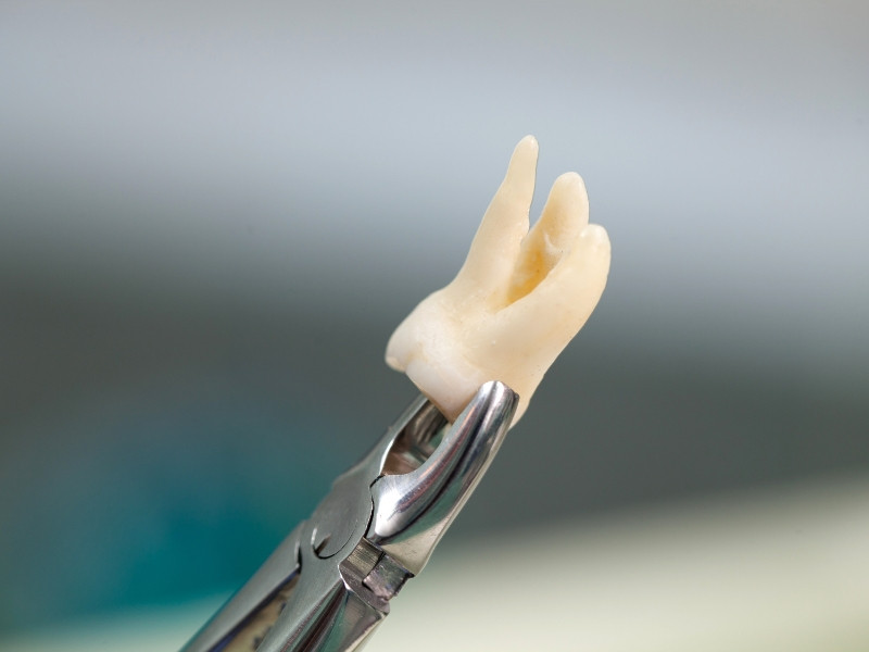 Consulta de Medicina Dentária para Extração Dental