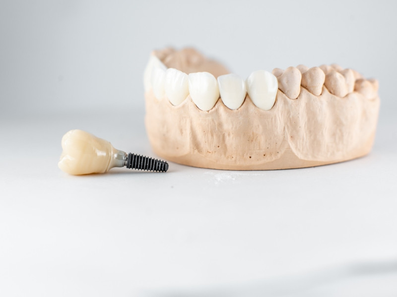 Consulta de Medicina Dentária para Próteses Sobre Implantes