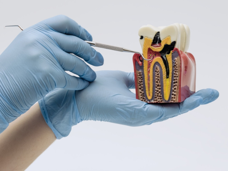 Tratamento de Desvitalização Dentária