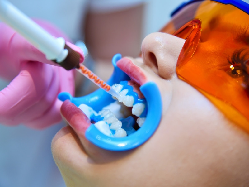 Consulta de Medicina Dentária para Branqueamento Dentário