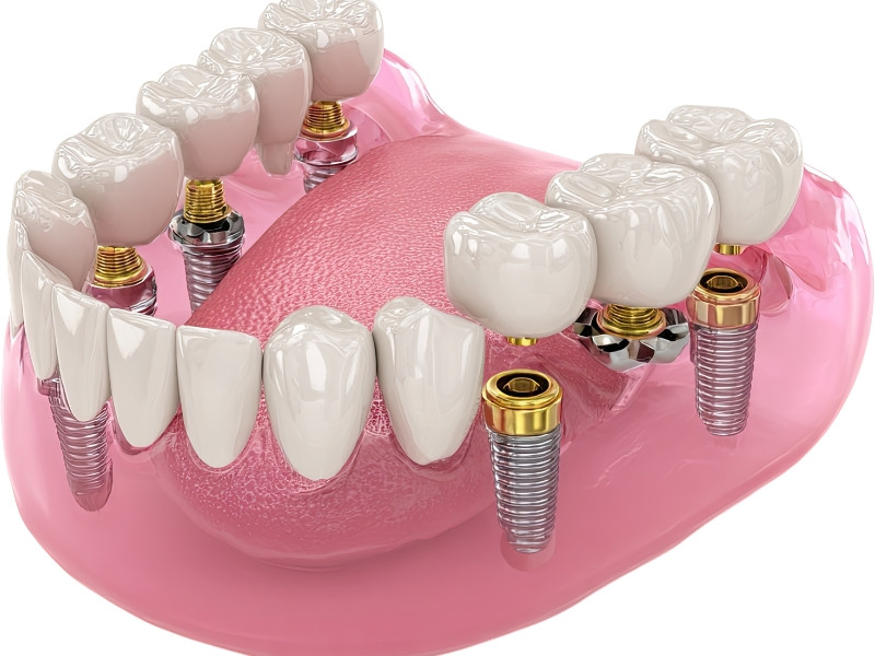 Prótese Sobre Implantes
