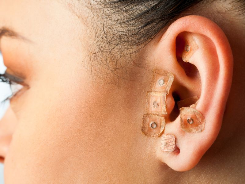 Auriculoterapia